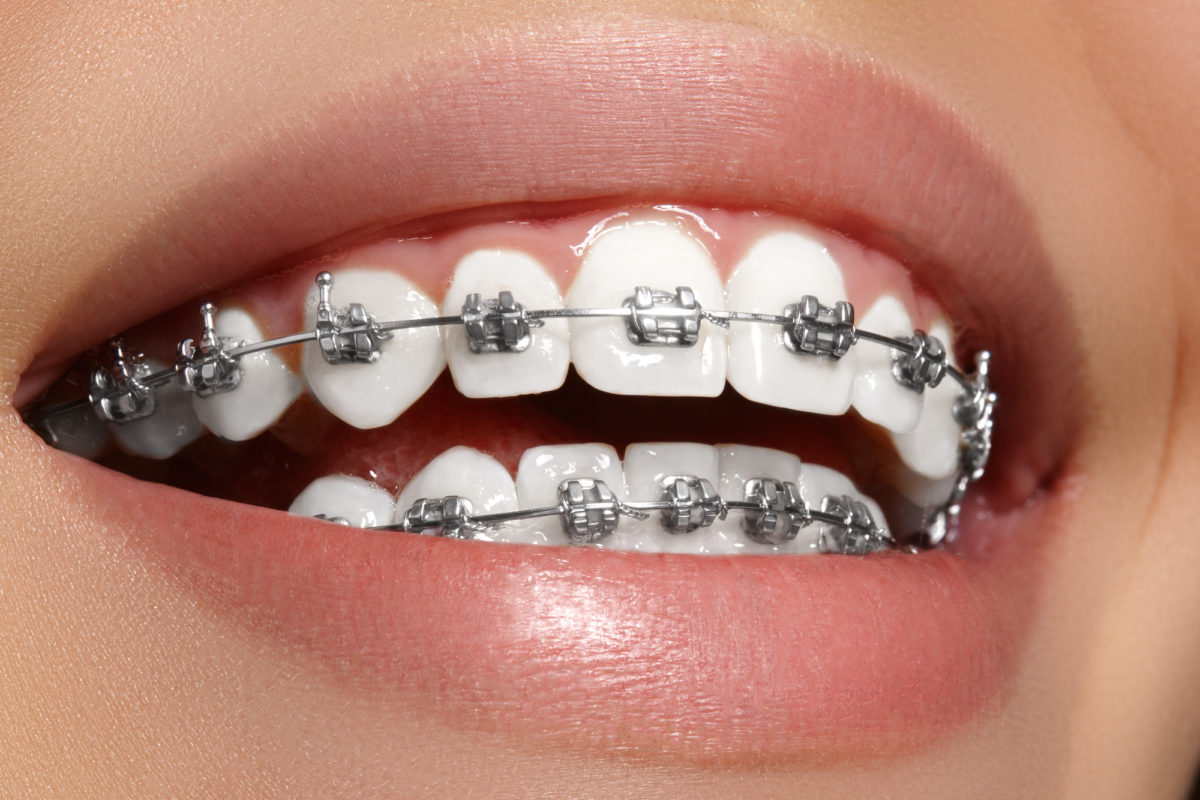 Braces Treatment